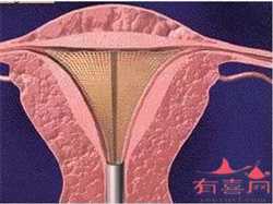北京代生公司有吗，试管助孕公司:子宫息肉女性试管助孕,进周前需要做什么准